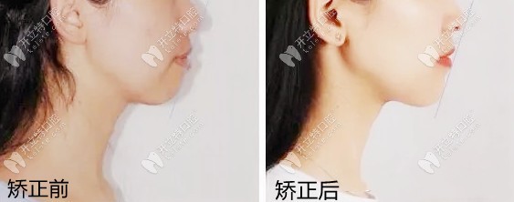 露齦笑戴陶瓷半隱形矯正有效果嗎？親身整牙經(jīng)歷來解答~