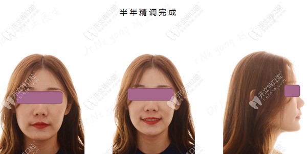 過(guò)了半年了，臉型還是有點(diǎn)變化的喲