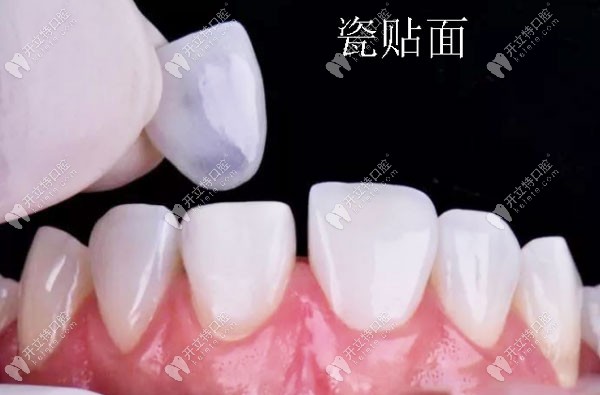 瓷貼面修復(fù)過(guò)程圖