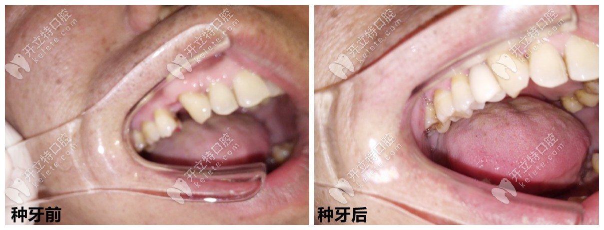 石家莊中諾口腔種牙好嗎？從種牙案例、醫(yī)生技術(shù)來看！