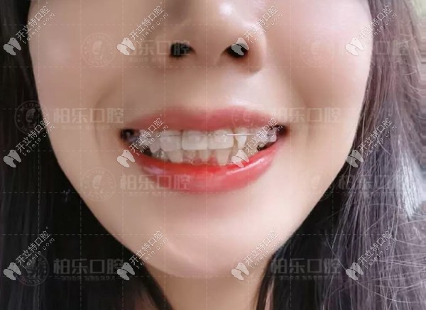 戴陶瓷隱形牙套三個(gè)月