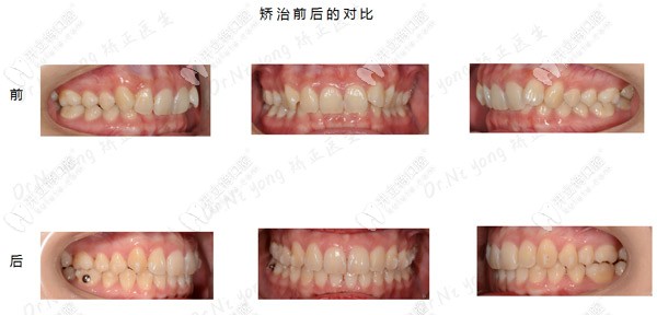 牙齒深覆合矯正前后對(duì)比