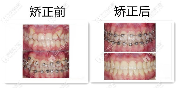 西安圣貝虎牙做矯正的效果圖