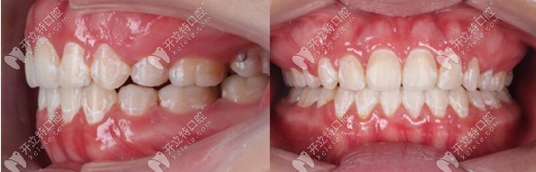 西安鼎秀齒科金屬自鎖案例