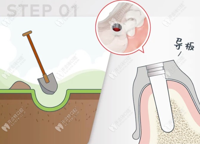種牙與種樹的對(duì)比