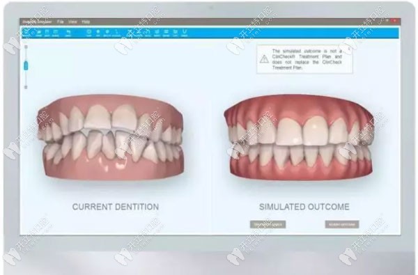 隱形牙齒矯正的3D動(dòng)畫(huà)模擬圖