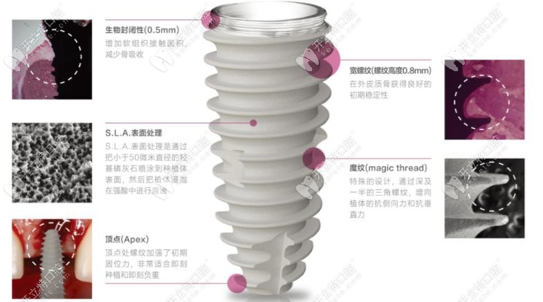紐百特種植體優(yōu)勢(shì)