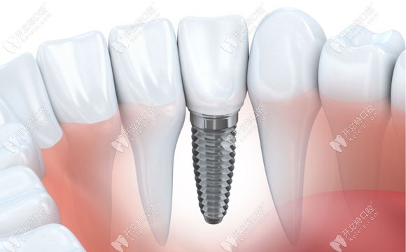 王國(guó)飛醫(yī)生擅長(zhǎng)多種牙齒種植技術(shù) 王國(guó)飛醫(yī)生擅長(zhǎng)多種牙齒種植技術(shù)