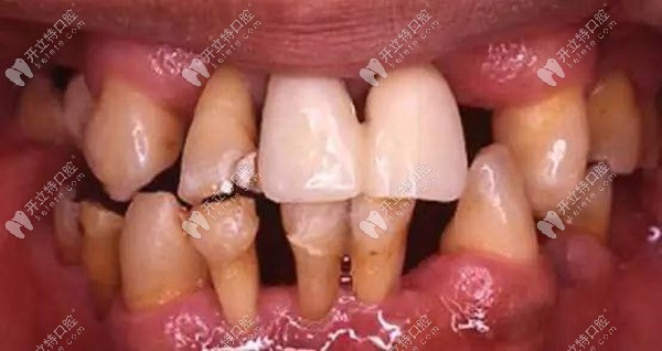 牙齦突然無緣無故出血,當(dāng)心是牙周炎在作祟！