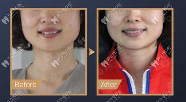 矯正前后的面部變化圖