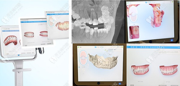隱形矯正的三維動畫圖