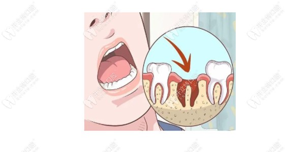 拔牙后留下的牙洞多長時間可以長平
