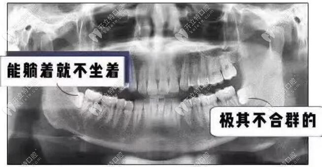 阻生牙、阻生智齒（橫著生長）