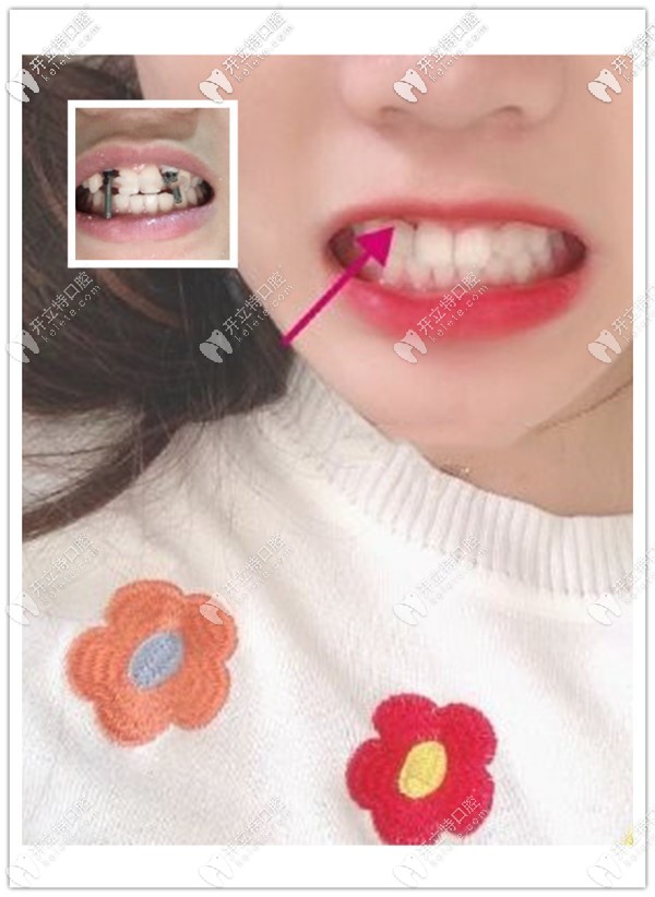 重慶美奧口腔黃澤源醫(yī)生給缺兩顆側(cè)切牙女孩用德國ICX種植體修復(fù)成功啦