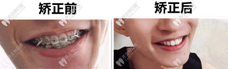 遺傳性兔牙：00后男生做美國3M金屬自鎖托槽矯正前后變化圖