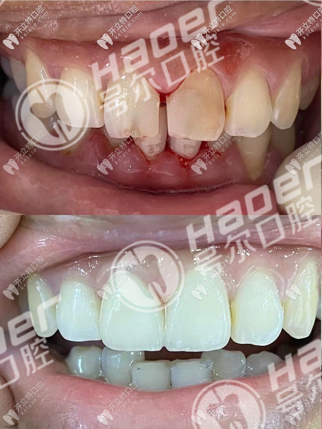 門牙做根管治療兩年后才選擇戴全瓷牙冠修復,效果還挺贊