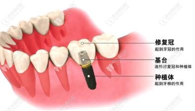 種植牙組成