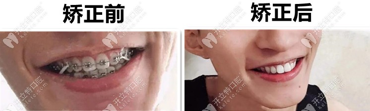 金屬自鎖托槽矯正后前后對(duì)比圖