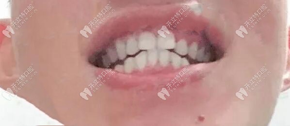正畸前-牙齒不齊 | 咬合不好