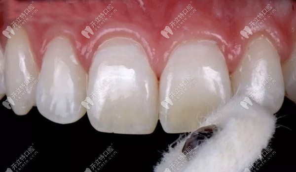 撤回橡皮障并對(duì)表面進(jìn)行拋光