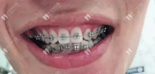 剛帶上自鎖牙套的樣子