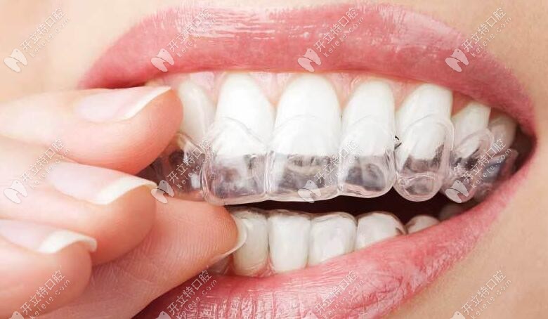 咬膠前牙套就位