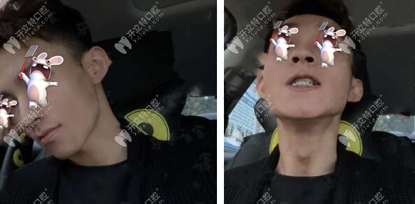 陽(yáng)光男孩：在長(zhǎng)沙德韓口腔做3M金屬托槽矯正