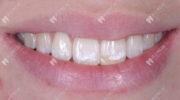 滲透樹脂治療氟斑牙的效果怎么樣，請(qǐng)看案例