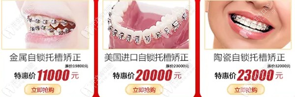 傳統(tǒng)托槽矯正器