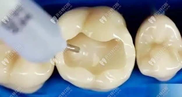 壞牙清理干凈的狀態(tài)