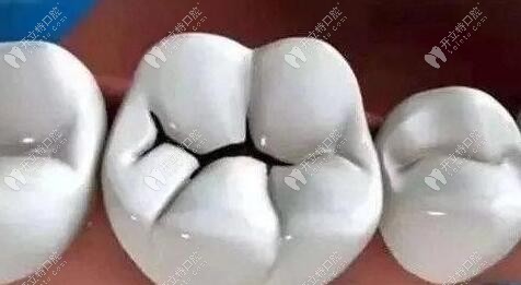 牙咬合面有黑線，輕微可補(bǔ)牙