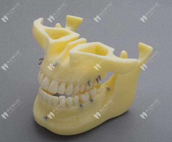 支抗釘在矯正過(guò)程中可適用的位置