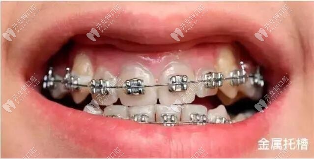 昆明德韓口腔戴普通鋼牙套要多少錢?快問下牙齒矯正價(jià)格表