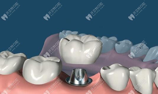 植入基臺后安裝牙冠完成修復(fù)