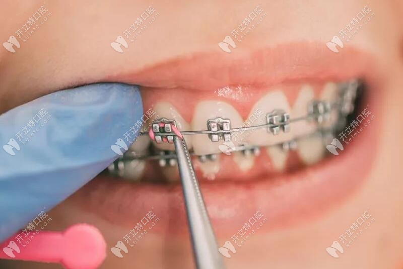 金屬牙齒矯正活動