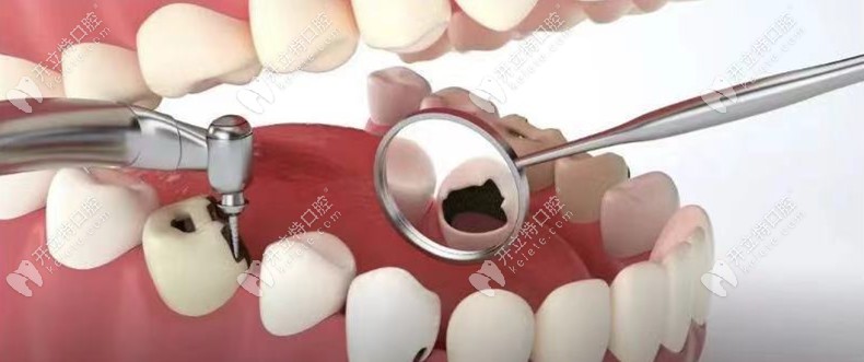 蛀牙不嚴(yán)重為什么要及時(shí)補(bǔ)牙，窩溝齲黑線是否要補(bǔ)牙呢？