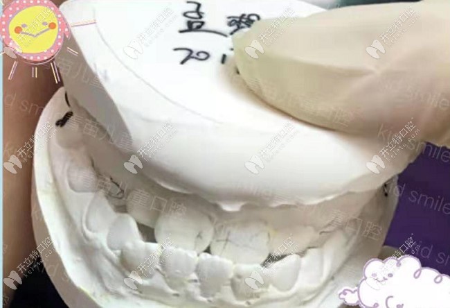雖然羅慕矯正器費(fèi)用貴,但兒子地包天戴了8個(gè)月效果就出來(lái)了