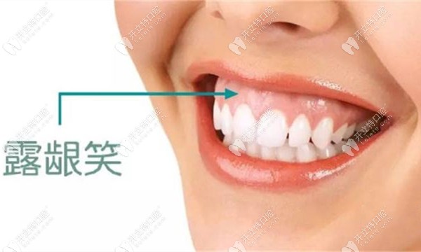 打骨釘可以有效改善露齦笑這我知道,但會不會反彈呢？