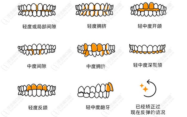 EASY SMILE牙套適應(yīng)癥
