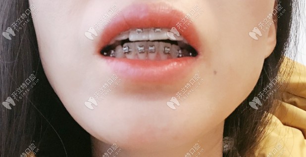 矯正中牙齒有變化