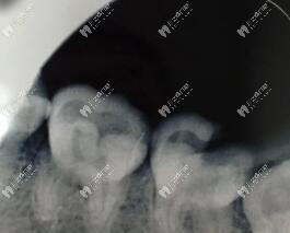 聽說蛀牙爛到牙髓不能直接補(bǔ)牙,那蛀牙疼是不是爛到神經(jīng)了?