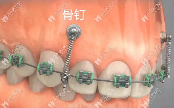 打骨釘改善露齦笑示意圖