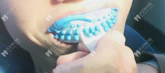 當(dāng)天咬模型