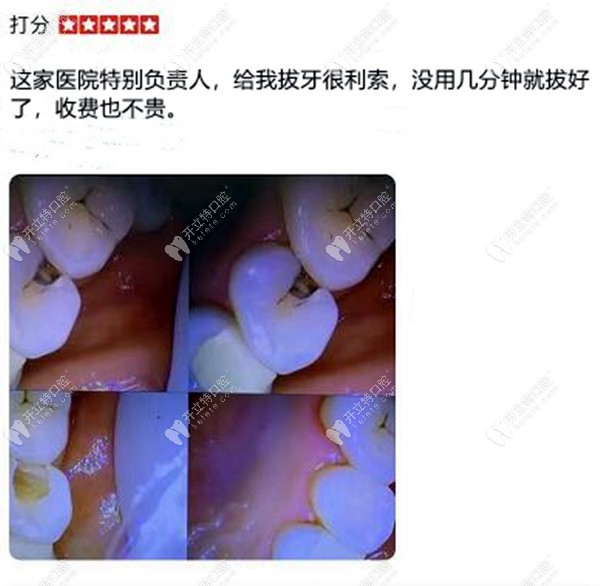 拔牙顧客評價藍天口腔