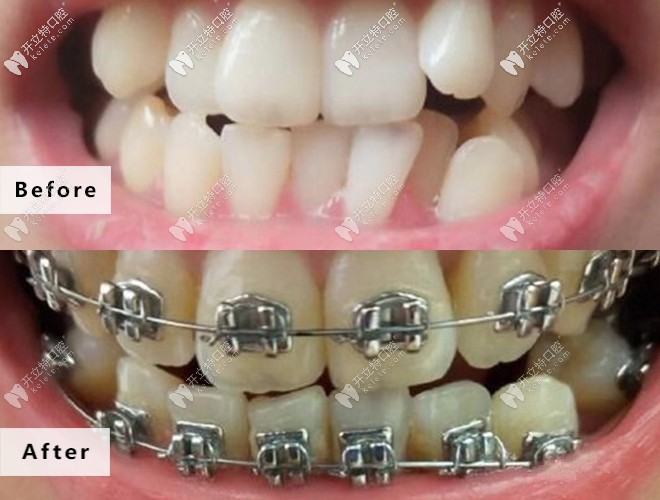 牙列擁擠+咬合紊亂不用怕!請參考我在皓清齒科的矯正效果