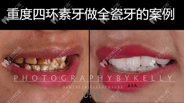 深圳麥芽口腔王長(zhǎng)晟醫(yī)生的全瓷牙案例