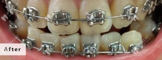 戴牙套一年零三個(gè)月的變化 戴牙套一年零三個(gè)月的變化