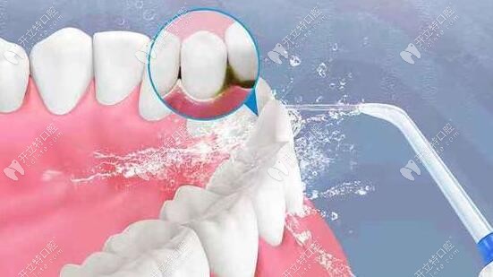 科普：洗牙時(shí)有哪些需要注意的？分享我的洗牙感受給你！