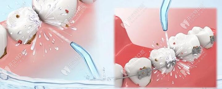 洗牙可是不會(huì)疼的，就是有點(diǎn)小麻