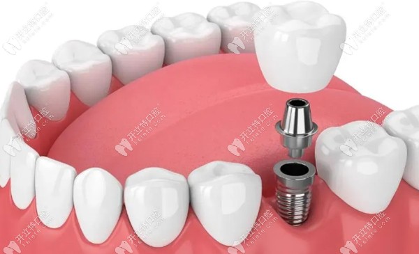 種植牙新品：德國(guó)瑞鈦超級(jí)骨整合種植系統(tǒng)的優(yōu)勢(shì)特點(diǎn)